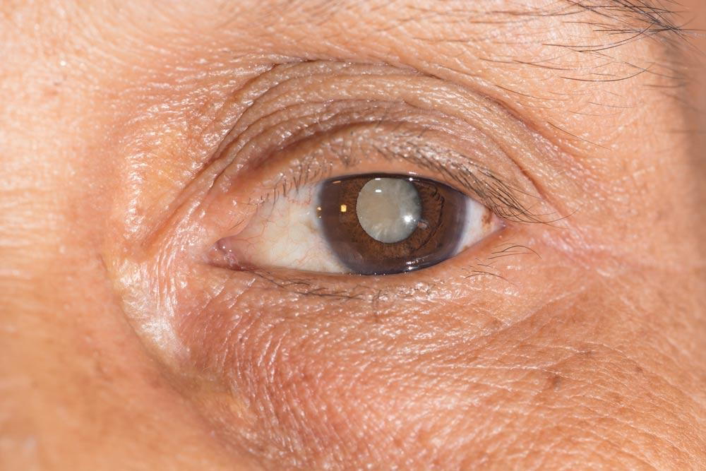 7 Sign Of Cataract